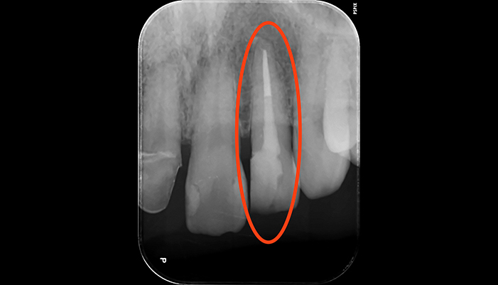 症例1 左上2 再根管治療