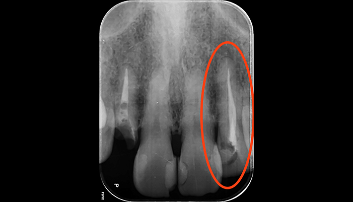 症例1 左上2 再根管治療