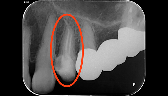 症例2 左上4 再根管治療