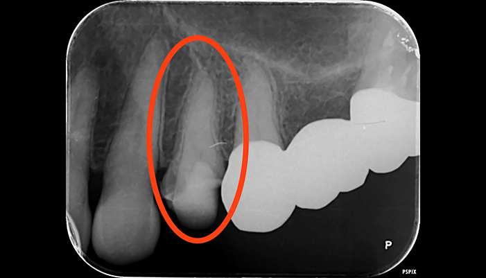 症例2 左上4 再根管治療