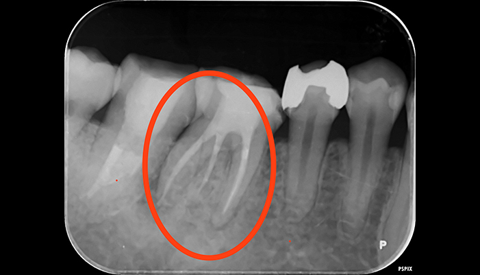 症例3 右下6 再根管治療