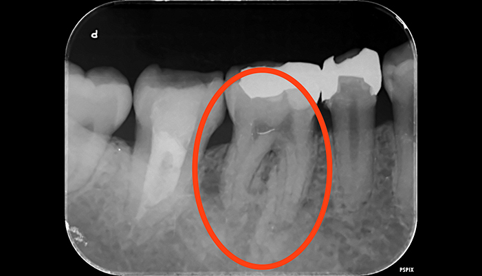 症例3 右下6 再根管治療
