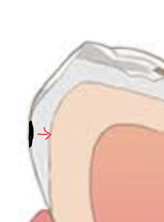 むし歯の進行速度