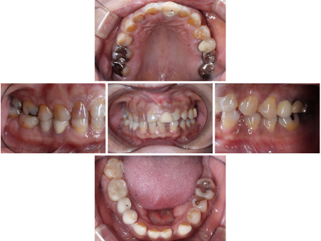 50代女性 上の歯全体の被せ物をやり直して噛み合わせと見た目を改善した症例