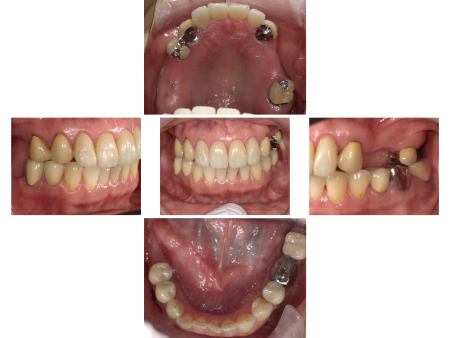 60代女性 欠損部位を「コーヌス義歯」で補いしっかり噛めるようにした症例