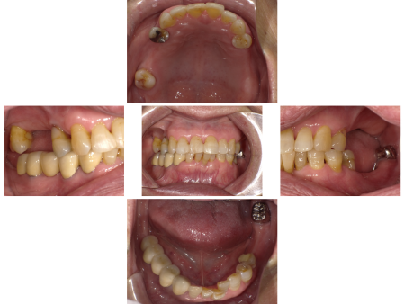 80代女性 部分入れ歯の修理と「ジルコニア」の被せ物で上の歯の噛み合わせを改善した症例