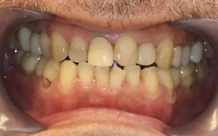 60代男性「前歯にひびが入っている」あごの動きを確認する「咬合診断」を行い、摩擦に強く耐久性がある「ジルコニアクラウン」で歯を保護する噛み合わせに改善した症例