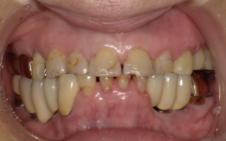 70代女性「綺麗な歯でしっかり噛めるようになりたい」歯に負担がかかる低い噛み合わせを、自然な白さで適合もよい「ジルコニアセラミック」を用いて総合的に治療し、見た目も美しく改善した症例