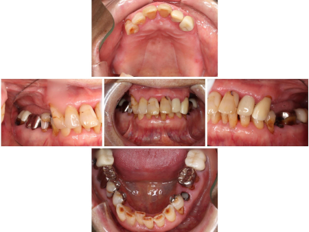 80代女性「よく噛めず、歯の見た目も気になる」加齢により低くなった噛み合わせを、白く適合の良い「ジルコニア」の被せ物と部分的な金属の入れ歯による全体的な治療で美しく改善させた症例