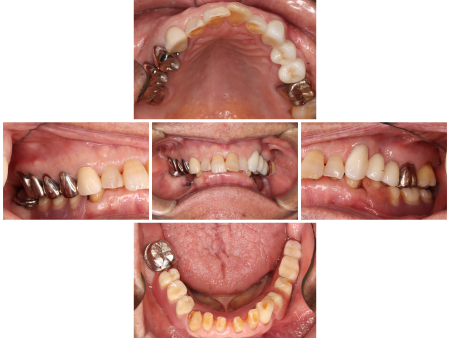 80代男性 破損した部分入れ歯を直す際に「ジルコニア」の被せ物治療を併用して全体の噛み合わせを改善した症例