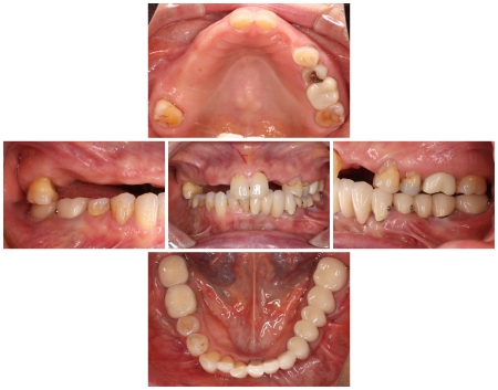 80代女性 咬合高径を高く調整したあと破損した部分入れ歯を作り直した症例