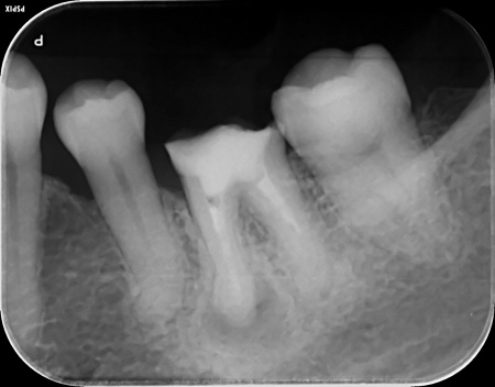50代女性 マイクロスコープを用いた精密な治療で歯の根に侵入した細菌を取り除きジルコニアクラウンで修復した症例